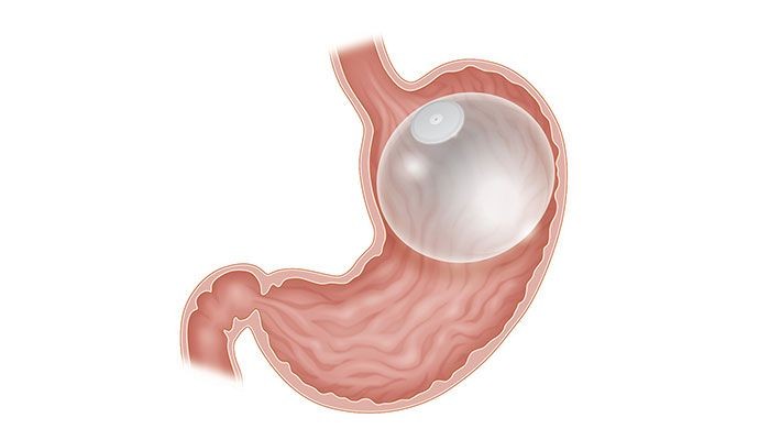 Endoscopic Gastric Balloon